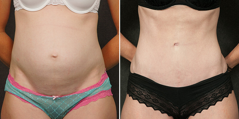 Abdominoplasty before and after