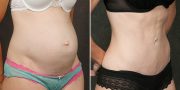 Abdominoplasty before and after