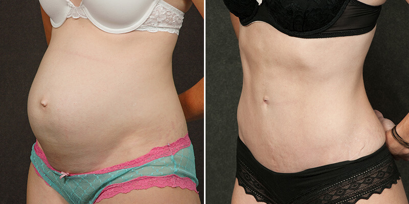 Abdominoplasty before and after