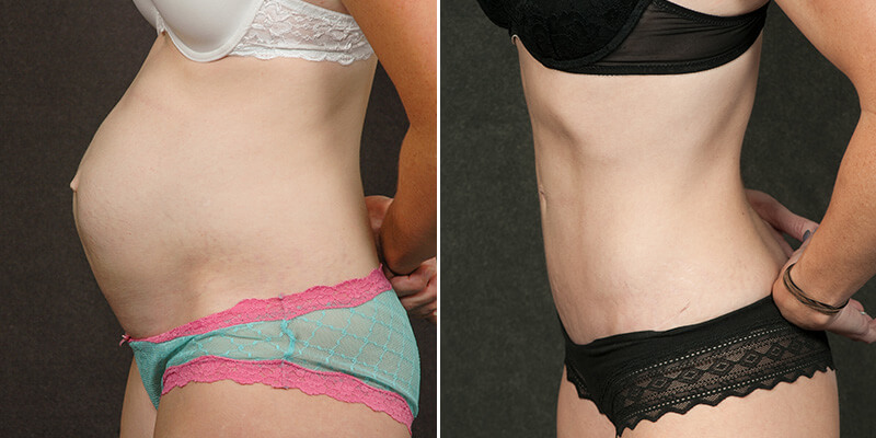 Abdominoplasty before and after