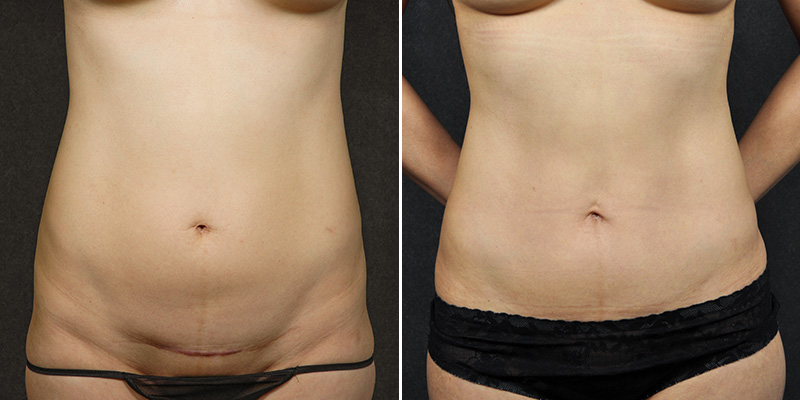 Abdominoplasty before and after