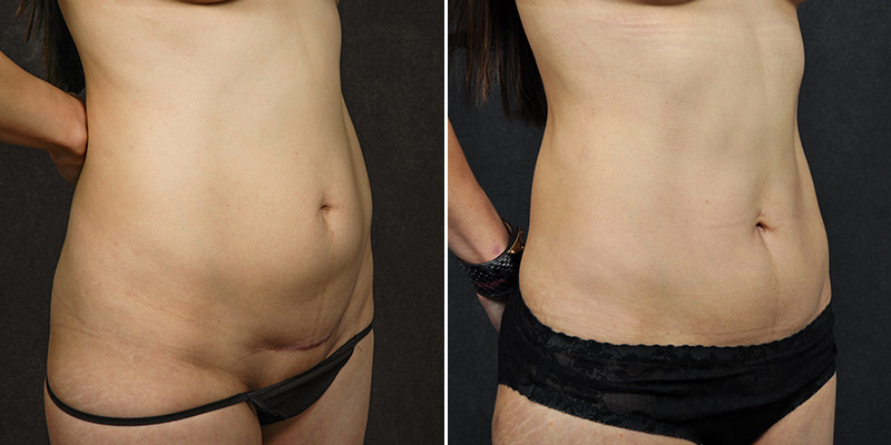 Abdominoplasty before and after