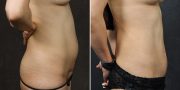 Abdominoplasty before and after