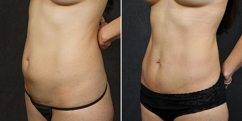 Abdominoplasty before and after