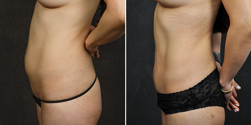 Abdominoplasty before and after