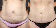 Abdominoplasty before and after