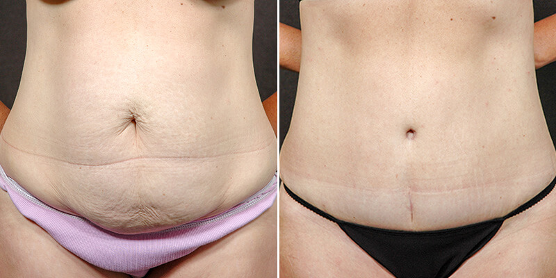 Abdominoplasty before and after