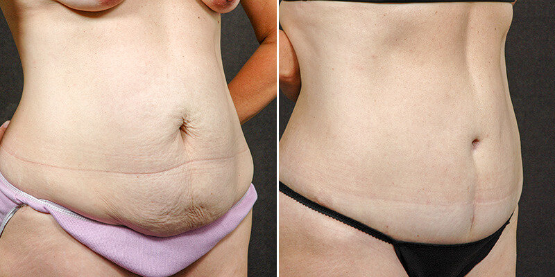 Abdominoplasty before and after