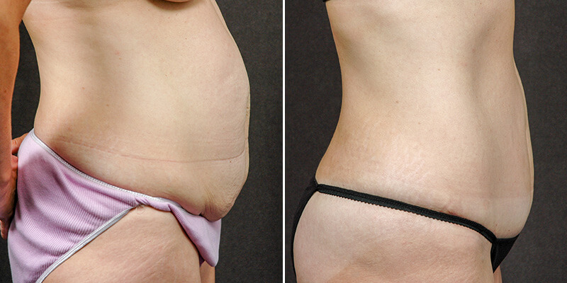 Abdominoplasty before and after