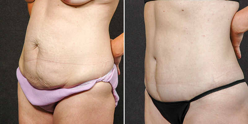 Abdominoplasty before and after