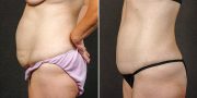 Abdominoplasty before and after