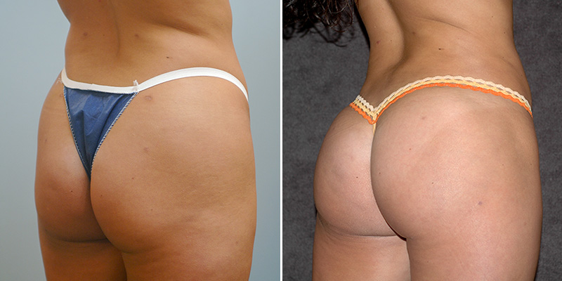 Brazilian Butt Lift before and after