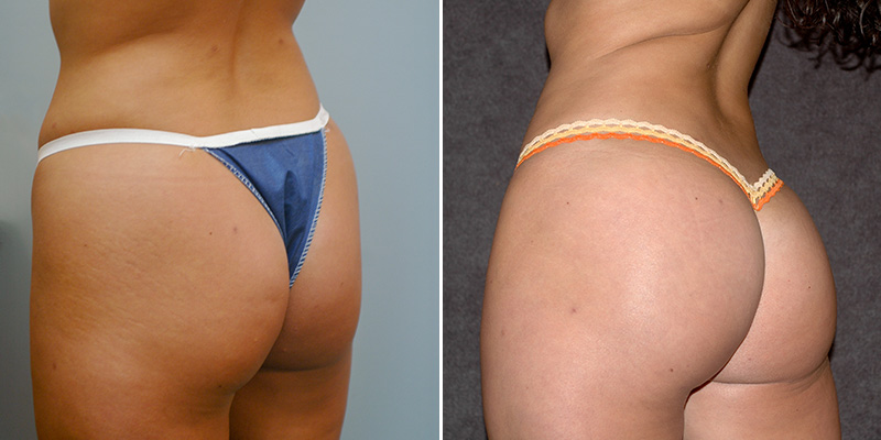 Brazilian Butt Lift before and after