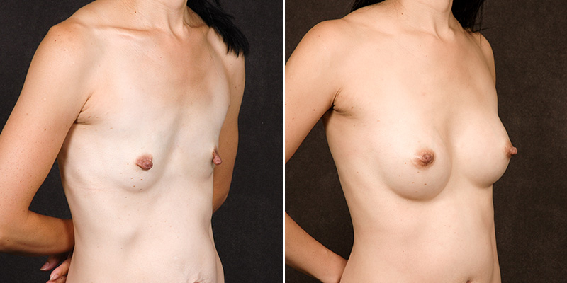 breast augmentation before and after