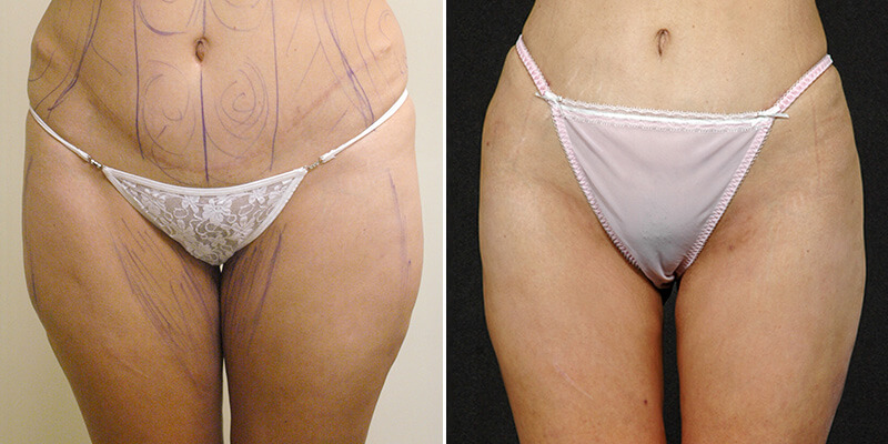 liposuction before and after