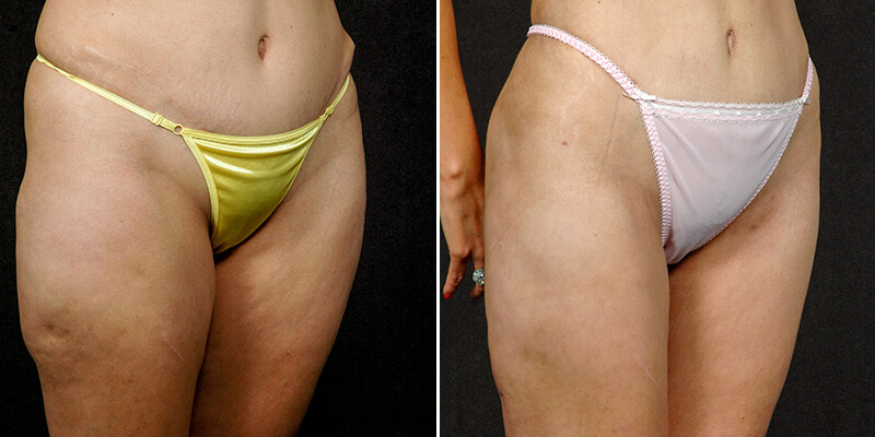 liposuction before and after