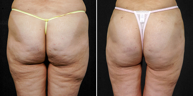 liposuction before and after