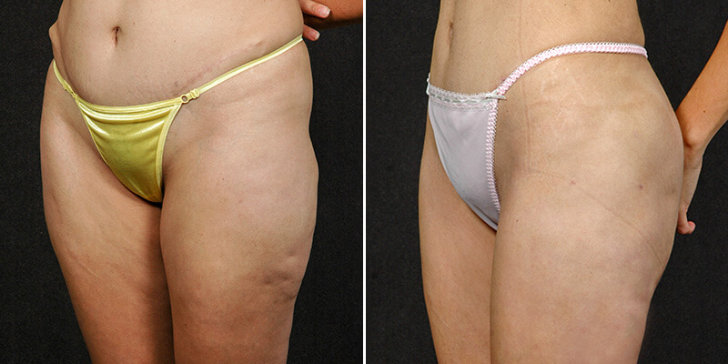 liposuction before and after