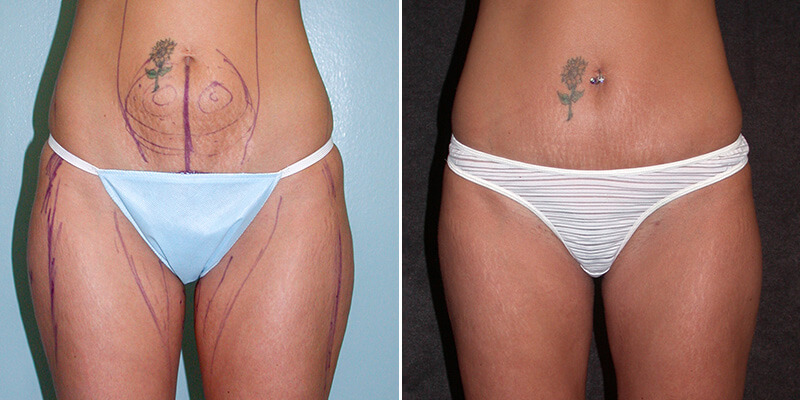 Tummy Tuck Scars Before and After Photo Gallery, Los Angeles, CA