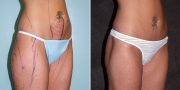 liposuction before and after