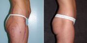 liposuction before and after