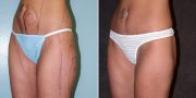 liposuction before and after