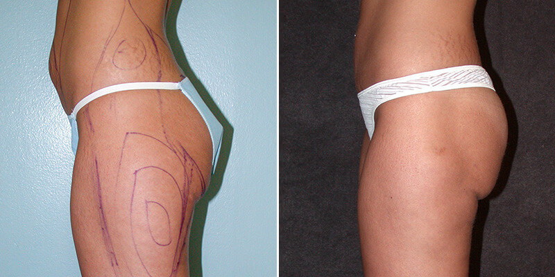 liposuction before and after