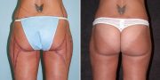 liposuction before and after