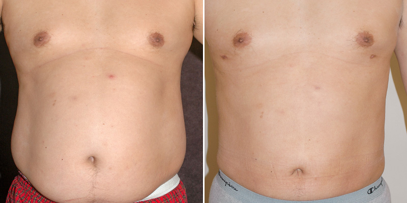 liposuction before and after