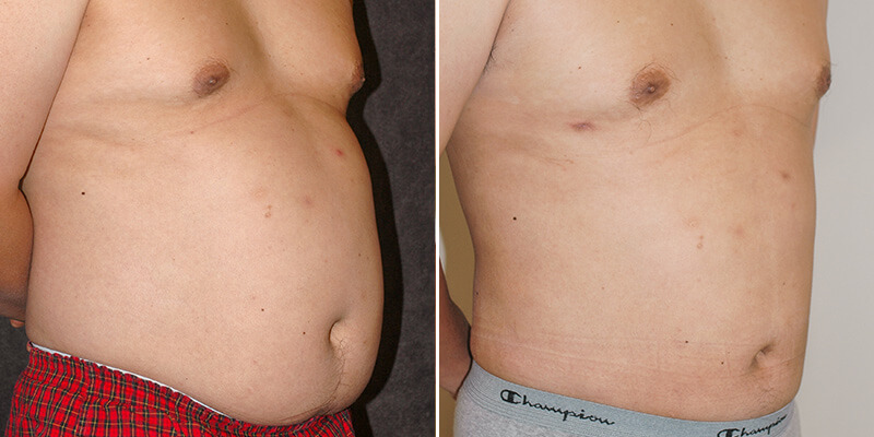 liposuction before and after