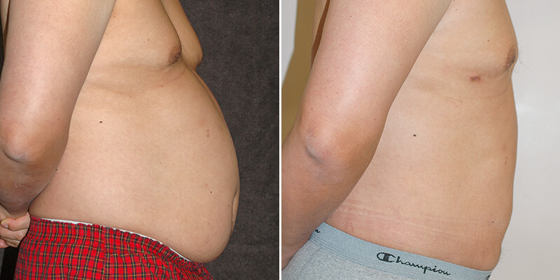 liposuction before and after