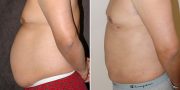 liposuction before and after