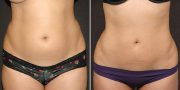 liposuction before and after