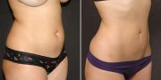 liposuction before and after