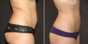 liposuction before and after