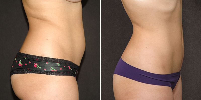 liposuction before and after