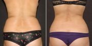 liposuction before and after