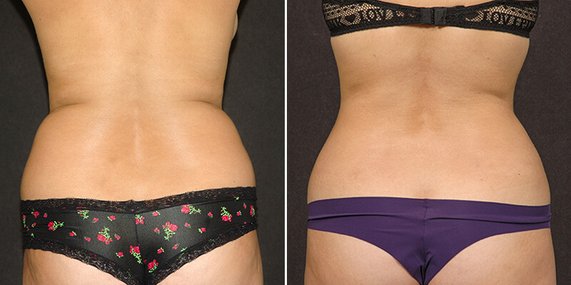 liposuction before and after