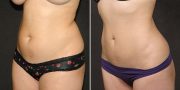 liposuction before and after