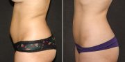 liposuction before and after