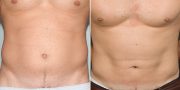 liposuction before and after