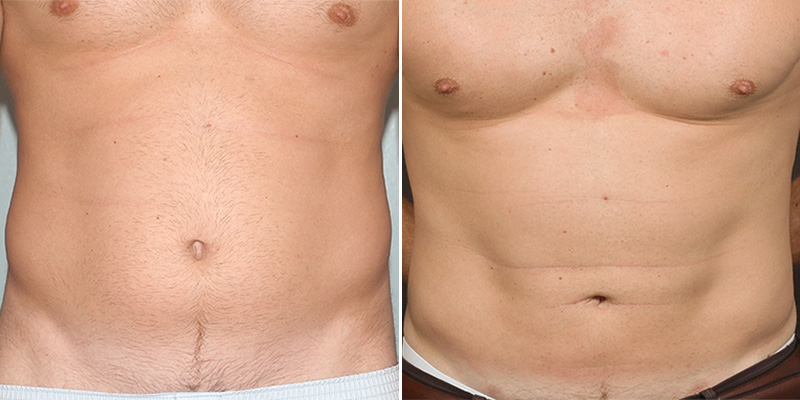 liposuction before and after