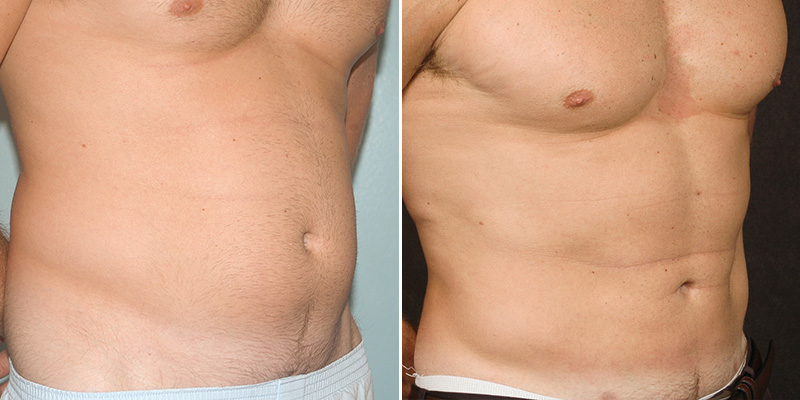 liposuction before and after