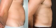 liposuction before and after