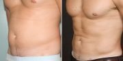 liposuction before and after