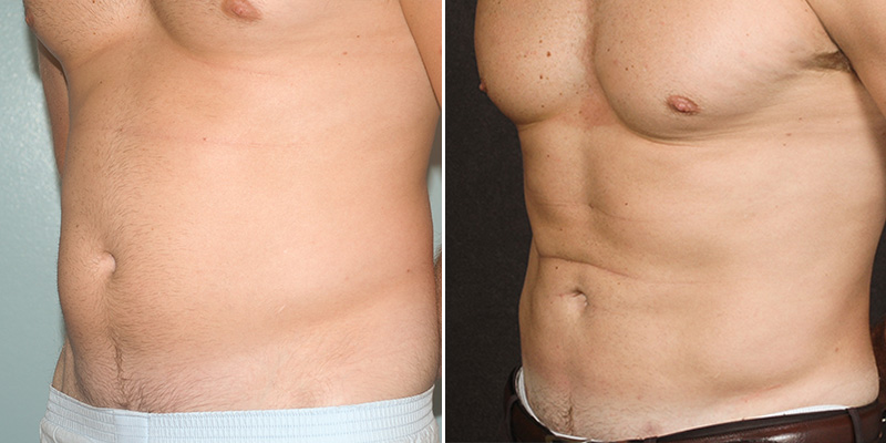 liposuction before and after