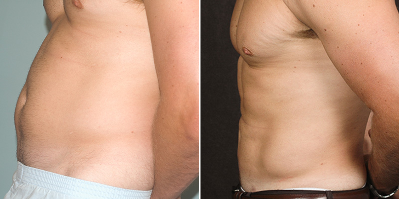 liposuction before and after