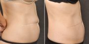 liposuction before and after