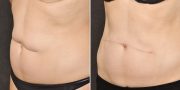 liposuction before and after