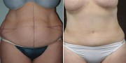 Dr. Kao Tummy Tuck (Abdominoplasty)